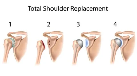 Total shoulder replacement Stock Illustration