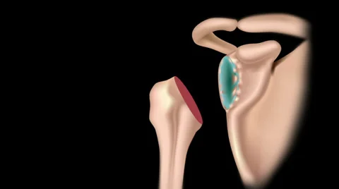 Total shoulder replacement surgery. 스톡 동영상 39095740