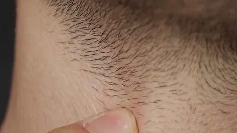 Touching a Red Pimple Located on The Neck Stock Footage
