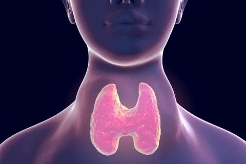 Toxic diffuse goiter, hyperthyroidism Illustrazione stock