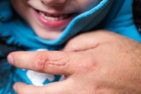 Trace of teeth bite on skin. Bad behavior of child Stock Photos