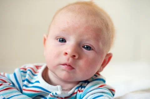 Traces of diathesis on the head Stock Photos