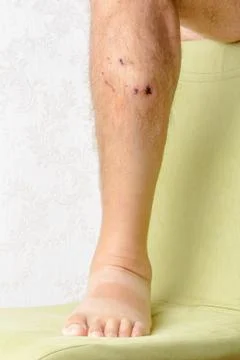 Traces of dog bites to the leg Фото