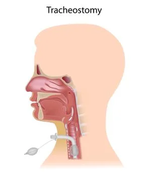 Tracheostomy Stock Illustration
