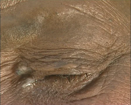 Trachoma 1 Stock Footage 39155789