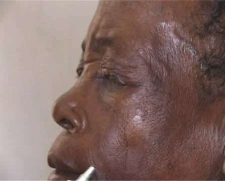 Trachoma. Eye operation Stock Footage 39156038