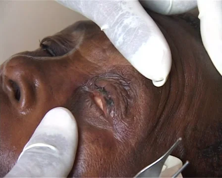 Trachoma. Eye operation Stock Footage 39156041