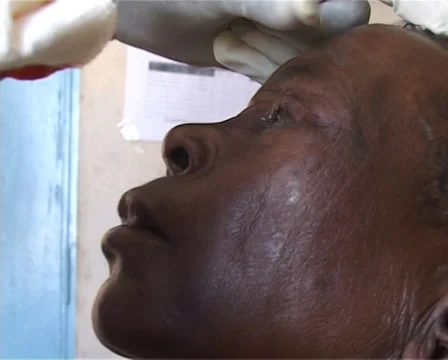 Trachoma Eye operation Stock Footage 39156302