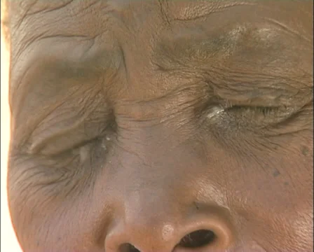 Trachoma Patient Stock Footage 39156676