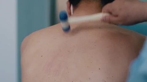 Traditional Fire Cupping Back Massage Therapy 4K Video stock 339321076