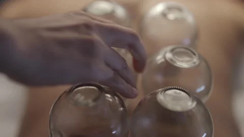 Traditional Fire Cupping Therapy Session Stock Footage 327516297