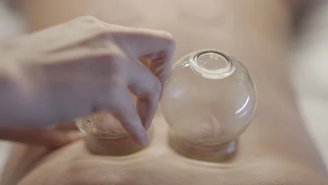 Traditional Fire Cupping Therapy Session Stock Footage 327516691