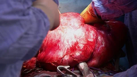 Training of surgeons in the operating room. Clouse-up. Vídeo Stock 150273897