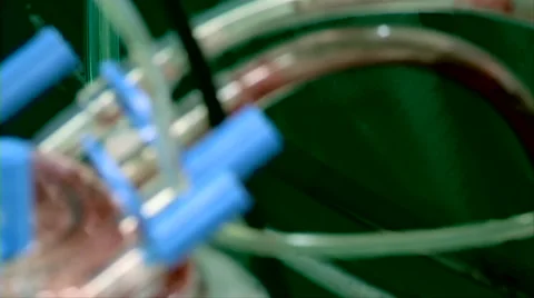 Transfusion blood flows through the tubes Stock Footage 42135593