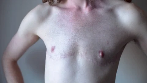 Transgender Man showing Surgery Scars on Chest Stock Footage 95743789