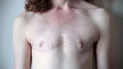 Transgender Man showing Surgery Scars on Chest Stock Footage 95749073