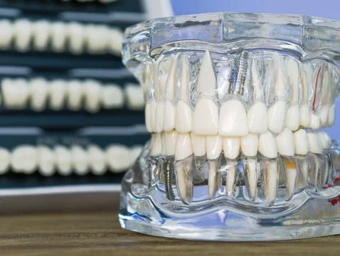Transparent dental model showcasing implants, roots, and root canal treatment Stock Photos