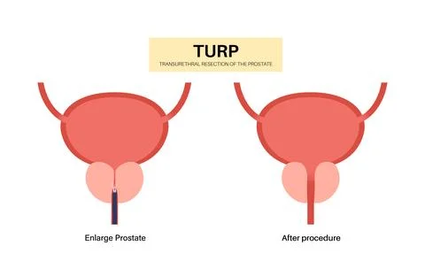 Transurethral resection of the prostate Stock Illustration