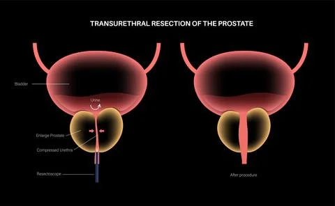 Transurethral resection of the prostate Stock Illustration
