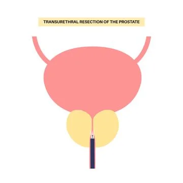 Transurethral resection of the prostate Stock Illustration