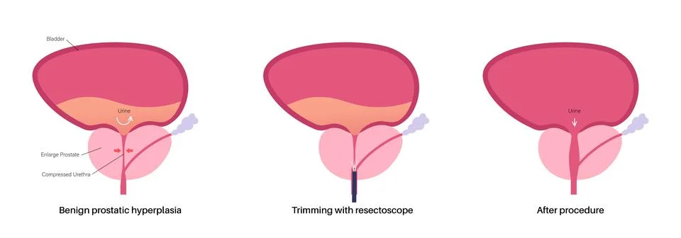 Transurethral resection of the prostate Stock Illustration