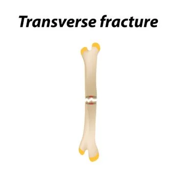 Transverse bone fracture. Infographics. Vector illustration on a lined Stock Illustration