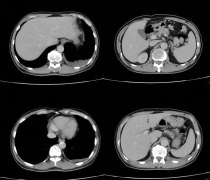 Transverse view or axial plain CT chest show Infitrative mass and nodules at  Stock Photos