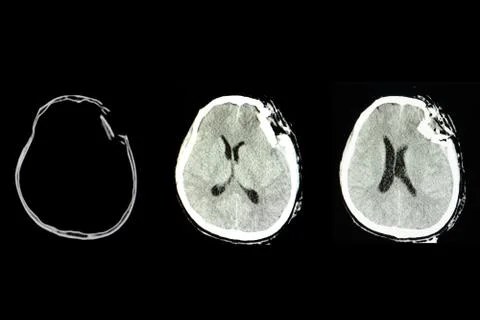 Traumatic brain injury Stock Photos