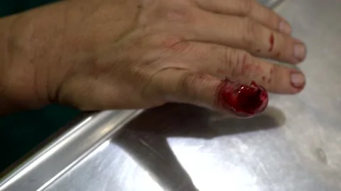 Traumatic Nail Extraction Stock Footage 144425583