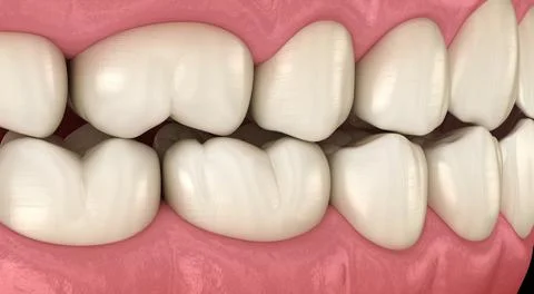 Traumatic Occlusion. Medically accurate 3D illustration Stock Illustration