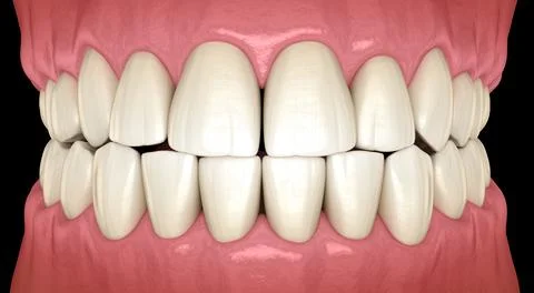 Traumatic Occlusion. Medically accurate 3D illustration Stock Illustration