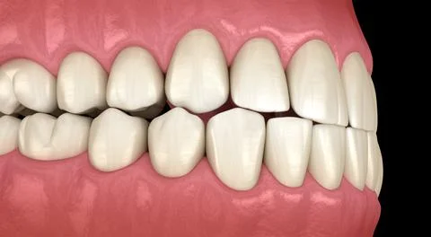 Traumatic Occlusion. Medically accurate 3D illustration Stock Illustration