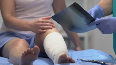 Traumatologist explaining x-ray results to patient with leg trauma, health care Stock-Footage 117380790