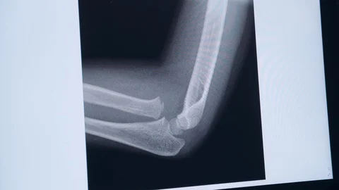 Traumatologist touches a touch screen with a x-ray of the bone Stock Footage 123560440