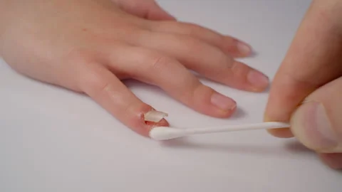 Treating damaged nail and finger wound with cotton swab Stock Footage 328624112