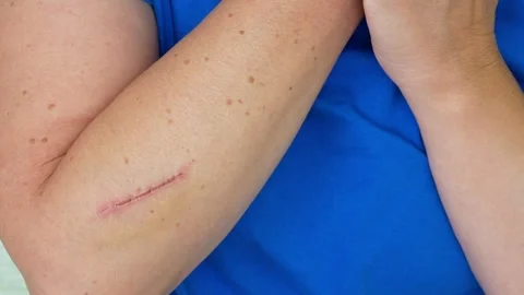 Treating a deep cut on the hand  Scar on hand. Cut and wound in the skin.. Stock Footage 295215277