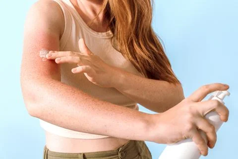 Treating Sunburn With Protective SPF Moisturizing Skincare Lotion Or Cream Stock Photos