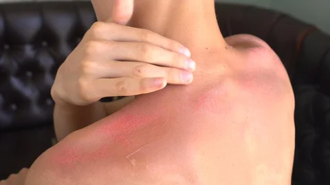 Treating sunburn. Using an antibiotic ointment on the wound Stock Footage