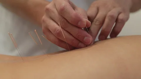 88 Electro Acupuncture Stock Video Footage - 4K and HD Video Clips