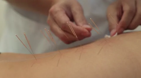 Treatment by Acupuncture Stock Footage 52542501