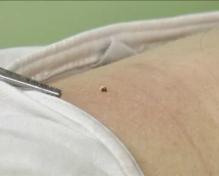 Treatment Bees Stock Footage 40414664