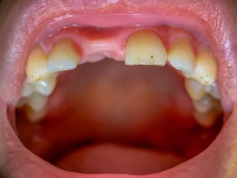 Treatment of diseased teeth. missing teeth Stock Photos