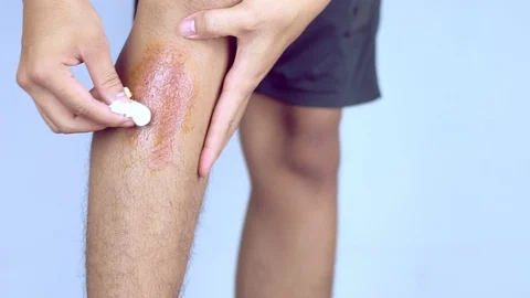 Treatment of leg wounds by himself, using patches to the wound. Caused by acc Stock Footage 91096979
