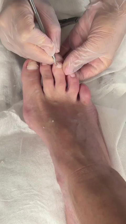  Treatment of problem nails during a pedicure Vidéo 336392055