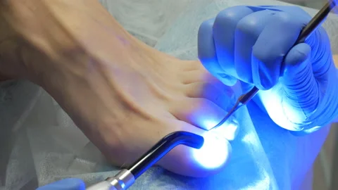 Treatment of psoriasis of nails by ultraviolet Stock Footage 101308010
