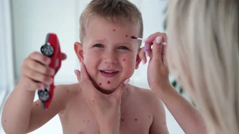Treatment of ulcers from chickenpox Stock Footage 200760815