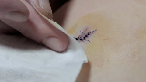 Treatment of the wound after surgery to remove a mole on a female leg, treatment Video stock 199623577