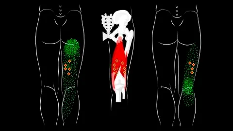 Trigger points and reflected pain in the hamstring muscles. Stock Illustration