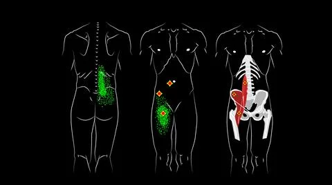 Trigger points and reflected pain in psoas major muscle, msoas minor muscle a Stock Illustration