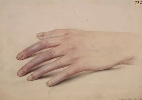 Trophic changes in the hand of a patient whose median nerve was divided Illustrazione stock